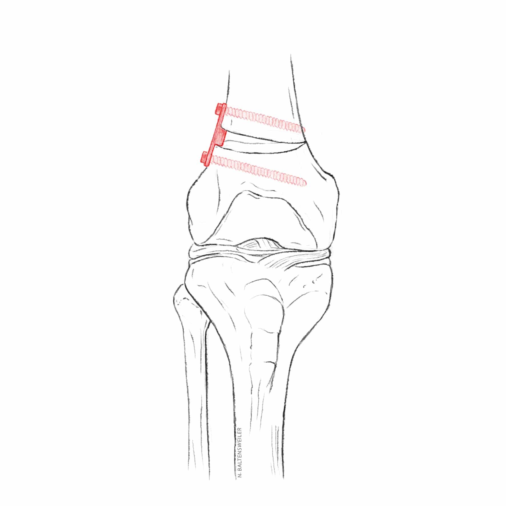Suprakondyläre Femur-Osteotomie | Orthobudic